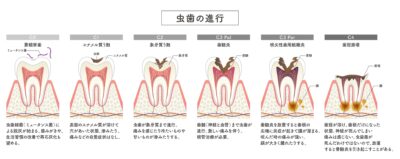 虫歯の進行度