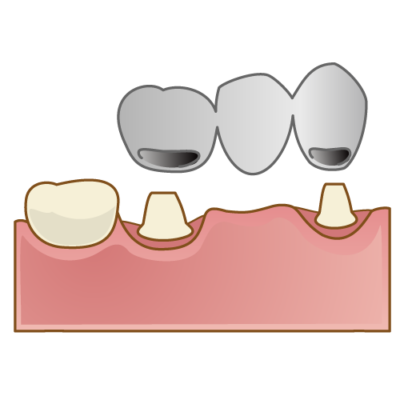 銀歯のブリッジイメージ