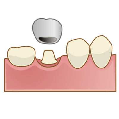 銀歯の被せ物イメージ
