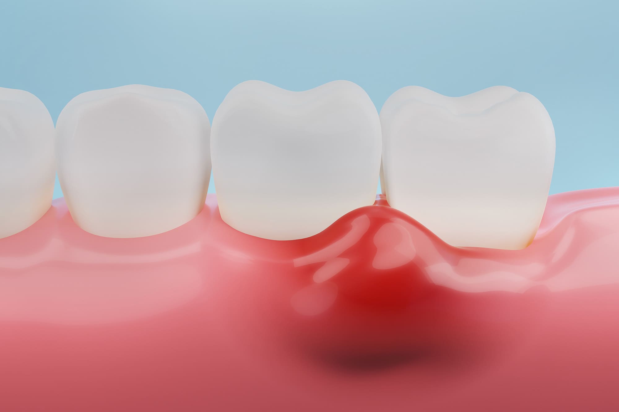 歯茎から膿が出る原因や対処法を紹介｜自分で潰していい？