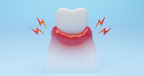 歯周病の症状をチェックリストや段階別で解説｜放置するリスクとは？