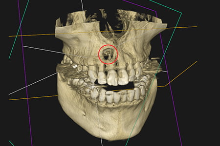 根管治療前の状態の画像