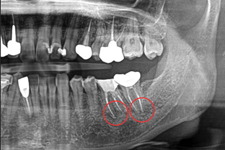 根管治療後の状態の画像