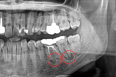 根管治療前の状態の画像
