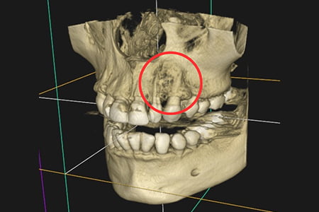 根管治療後の状態の画像