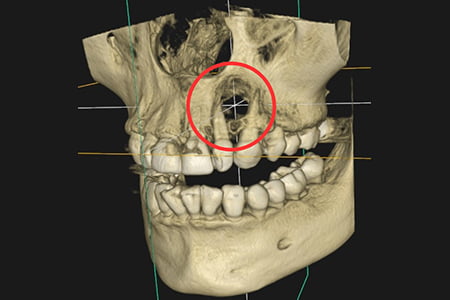 根管治療前の状態の画像