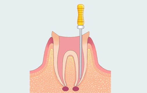 治療プロセス説明図
