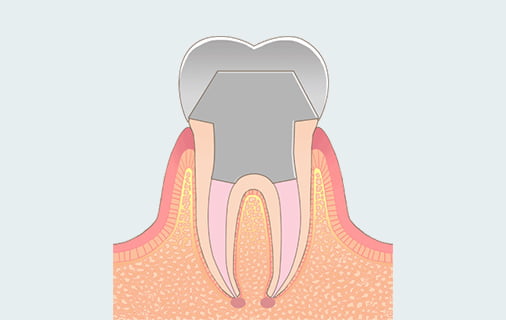 治療プロセス説明図