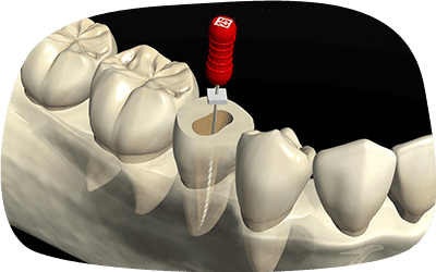 ニッケルチタンファイルを使用した根管治療