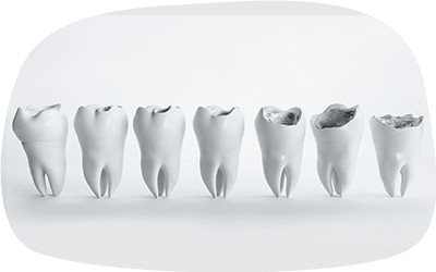 虫歯の進行によって削れいていく歯のイメージ画像