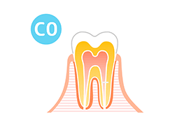 C0（脱灰）状態の歯の図解