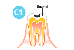 C1（初期虫歯）状態の歯の図解