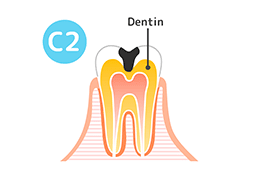 C2（象牙質の虫歯）状態の歯の図解