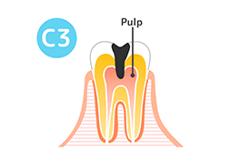 C3（神経に達した虫歯）の図解