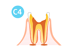 C4（歯根のみ残った虫歯）の図解