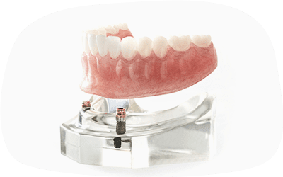 インプラントオーバーデンチャーの模型