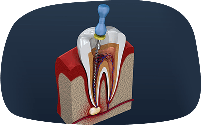 根管治療のイメージ画像