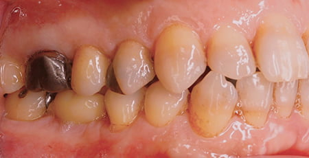 インプラント治療後の状態の画像