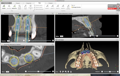 高精度のＣＴ撮影説明図