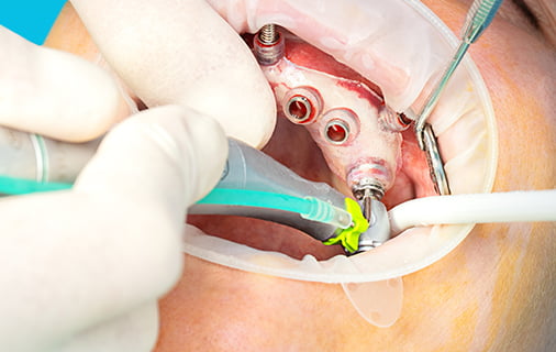 ガイドに沿ったドリリング・埋入の画像