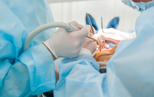 インプラント治療の説明図3