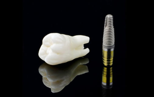 インプラント治療の説明図5