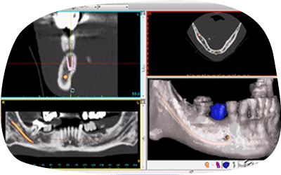 ガイデッドサージェリーを用いた綿密なシミュレーション説明図