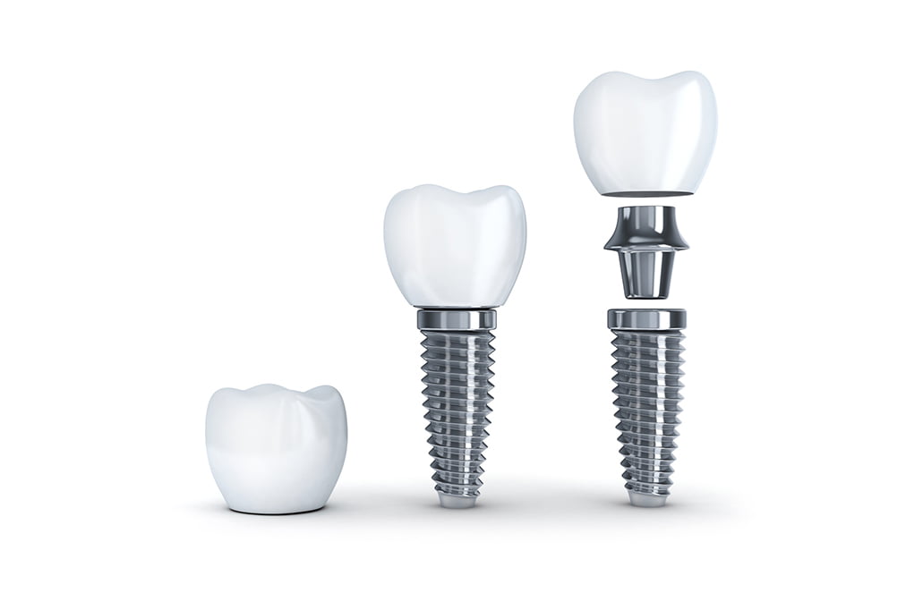 ノーベルバイオケアのインプラント図