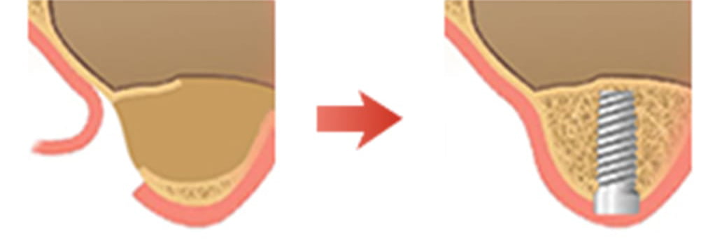 サイナスリフト説明図