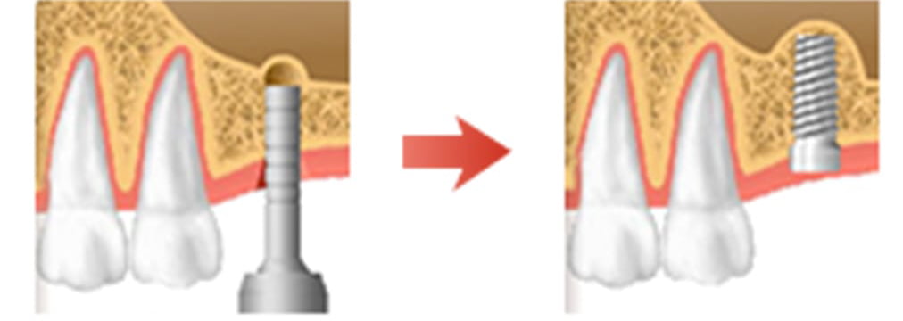 ソケットリフト説明図