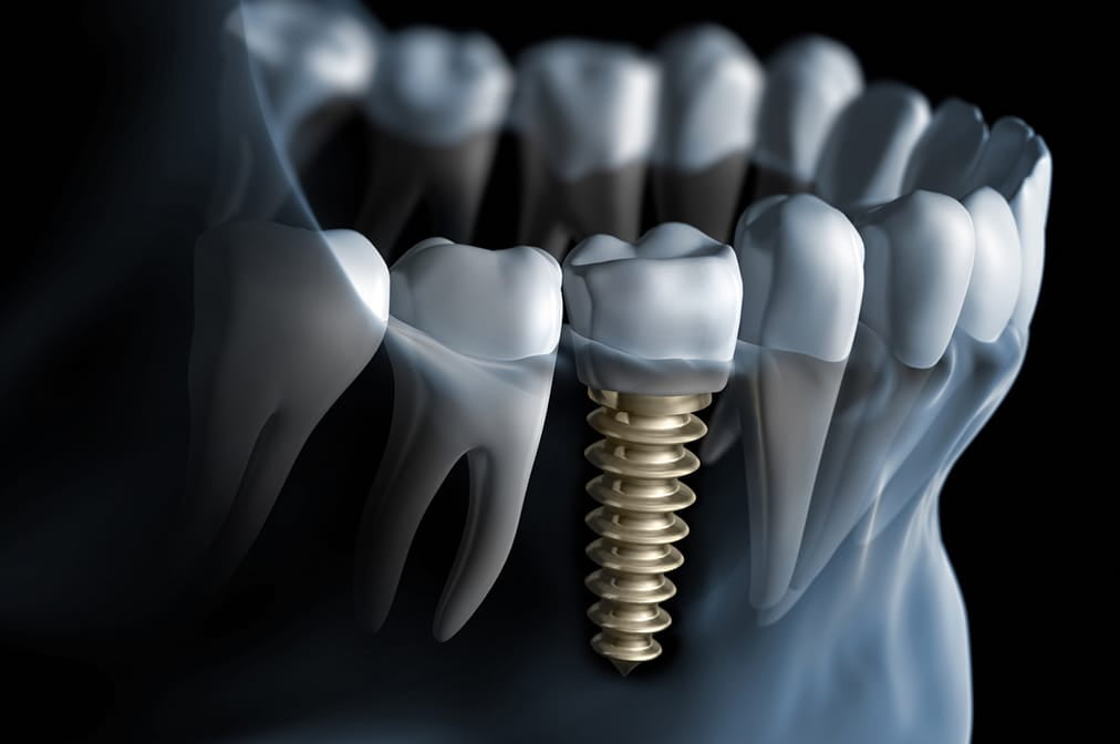 埋入手術、補綴処置の説明図