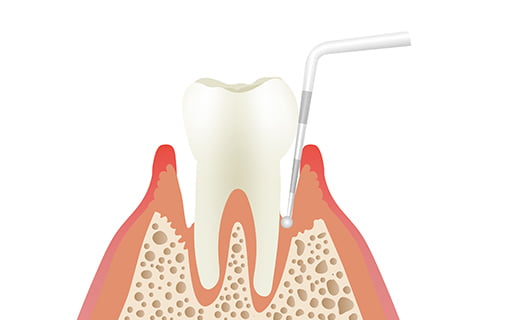 歯周ポケットのプローブ検査