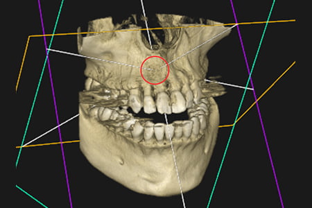 根管治療後の状態の画像