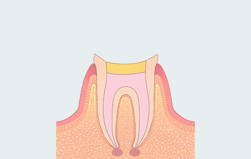 治療プロセス説明図